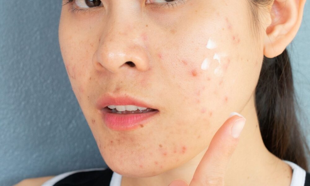 Acne mapping oily skin Acne on cheeks Acne on forehead Acne on chin Acne on nose Death triangle