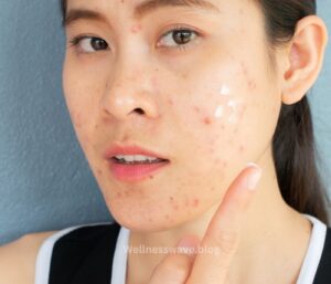 Acne mapping oily skin Acne on cheeks Acne on forehead Acne on chin Acne on nose Death triangle