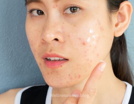 Acne mapping oily skin Acne on cheeks Acne on forehead Acne on chin Acne on nose Death triangle
