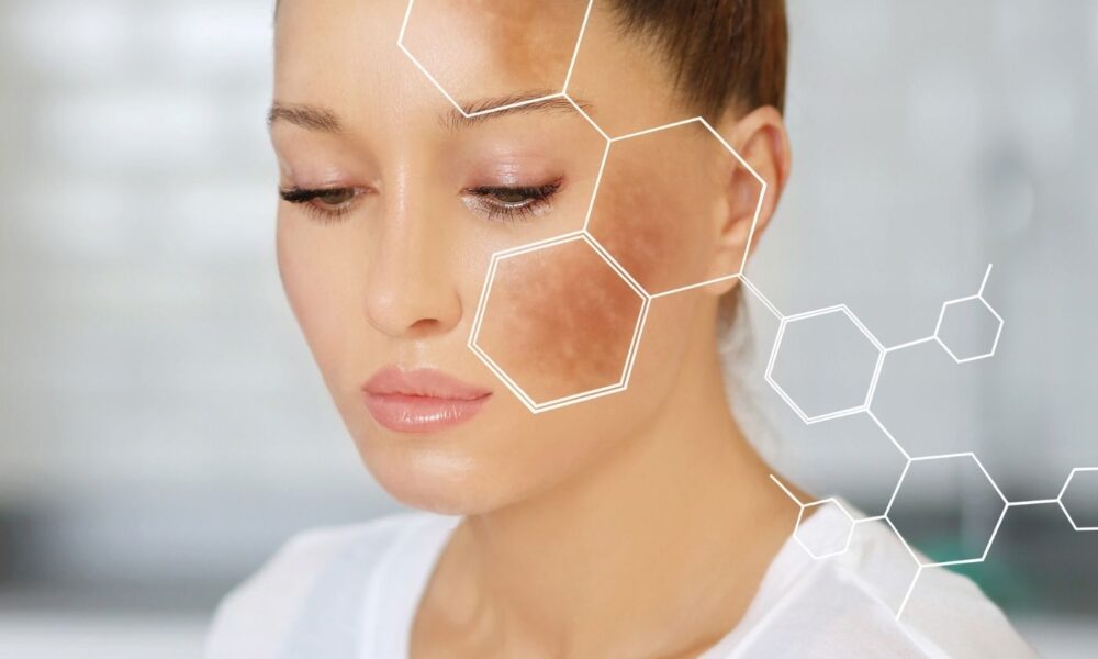 Hyperpigmentation
