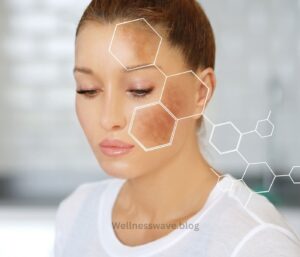 Hyperpigmentation